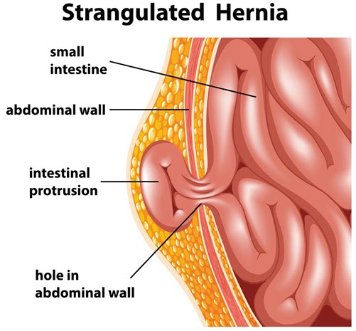 Femoral Hernia Repair, Dallas, TX