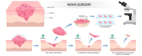 Mohs surgery basal cell microscopic reconstruction Paget's disease inflammation biopsy