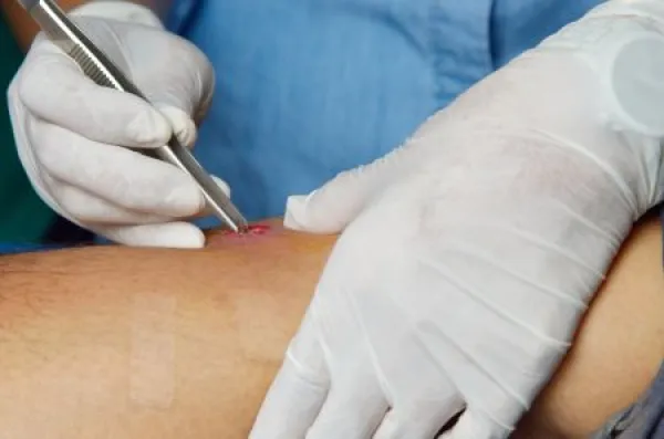 Nurse was drainage pus abscess.
