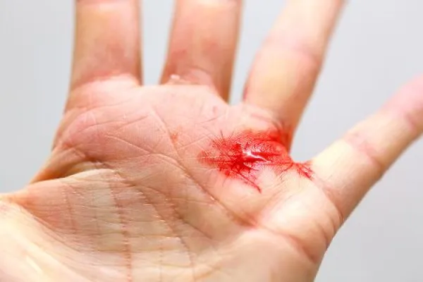 Close up of a bleeding cut hand with tiny shards of glass.