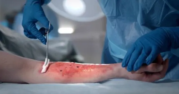 Downloaded Surgeons team working with burn wound on arm of patient in operating room.