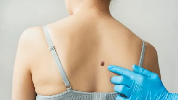 Examining skin for potential cancerous growths