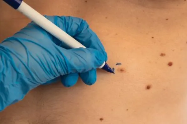 Preparing procedure for medical skin surgery. Unrecognizable Doctor in medical gloves paint lines around male birthmarks.