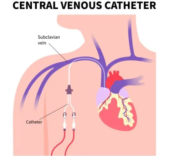 textbook illustration of central venous catheter in patient’s body