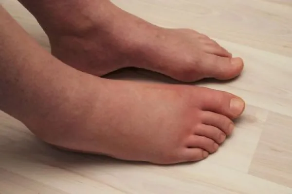 Allergic reaction to a wasp sting