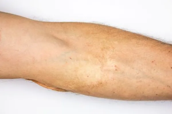 Burn scars, burn scars on the arm