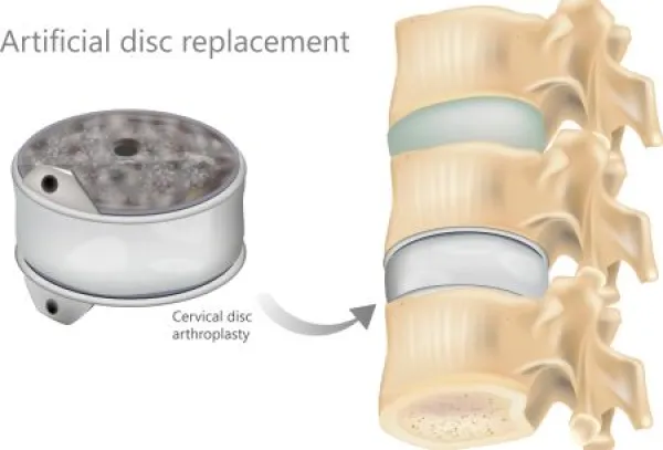artificial disc graphic