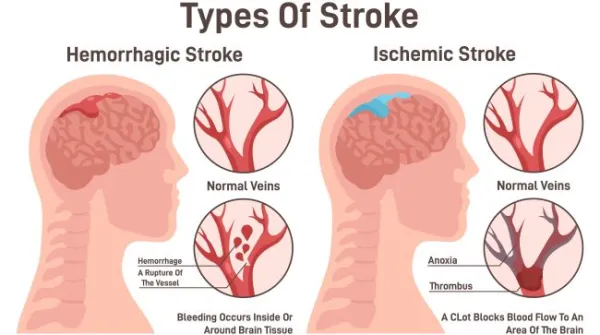 Stroke types set. Hemorrhagic and ischemic brain stroke. Damaged human