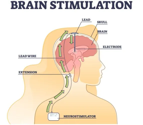 Deep brain stimulation procedure educational explanation outline diagram, transparent background.