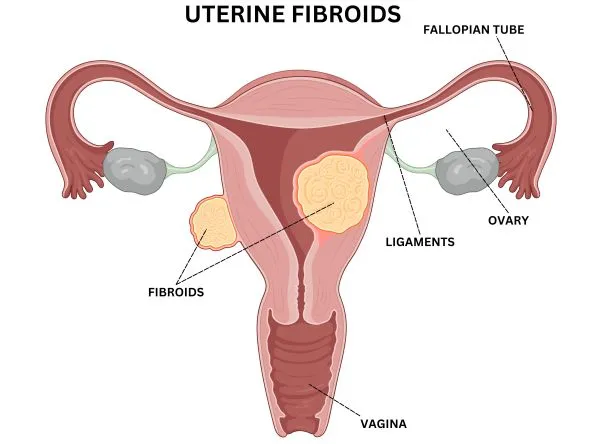 Uterine Fibroids Illustration – Female Reproductive System and Myometrial Growths Diagram