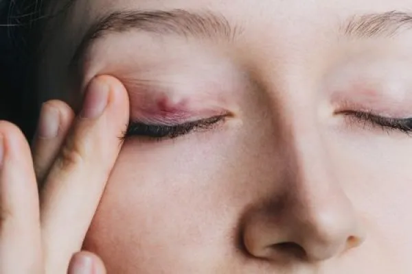 young girl shows a chalazion on the eyelid closeup 