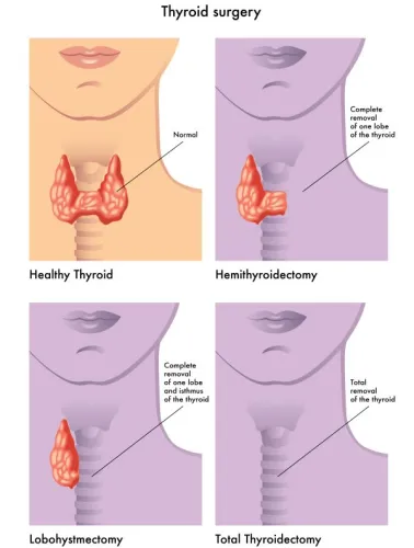 thyroid surgery