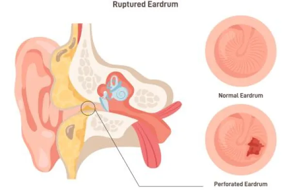 Ruptured eardrum. Anatomy of the human ear. Healthy and perforated