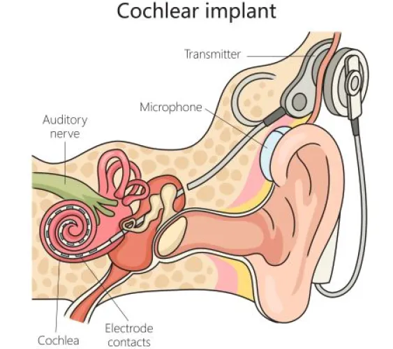 Medical illustration, cochlear implant, ear structure,