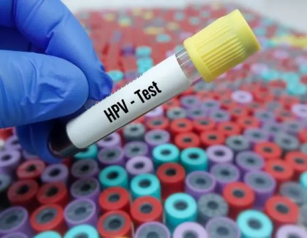 Medical Professional Holding HPV Test Tube for Laboratory Analysis.