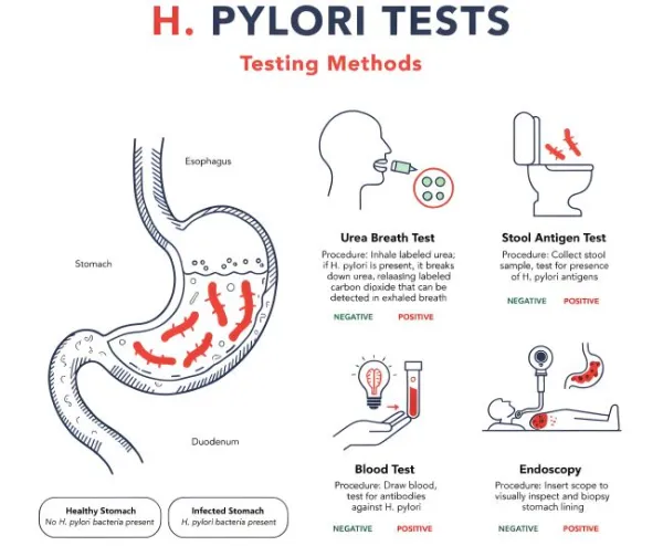 H Pylori Testing Methods Illustrated with Diagrams of Different Diagnostic Procedures