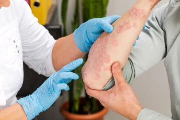 A dermatologist wearing gloves examines the skin of a sick patient.
