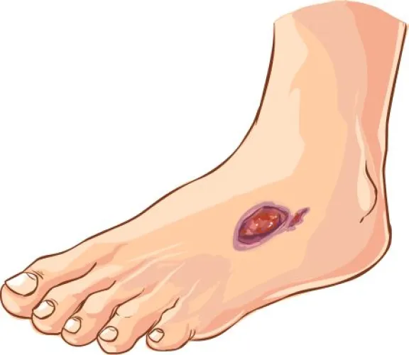 Vector illustration of a medical Diabetic foot