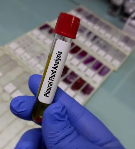 Downloaded Biochemist or medical technologist hold Pleural fluid analysis sample, Pleural effusion.