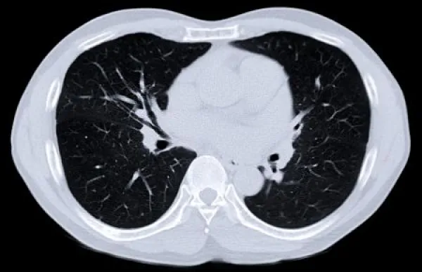 CT scan of Chest or lung for screening lung nodules and lung cancer .