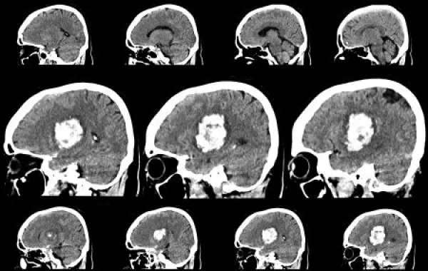 CT scan brain image showing intracerebral hemorrhage stroke