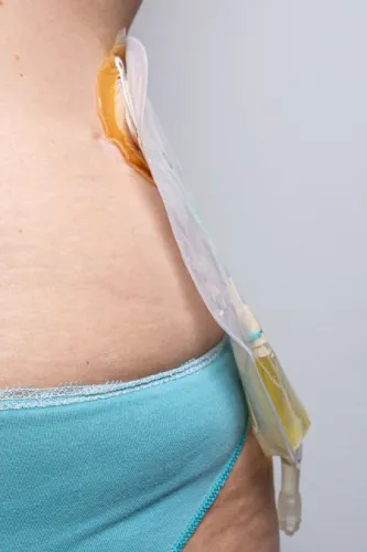 nephrostomy with a catheter tube between the kidney and a urine collection bag 