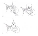 Partial Salpingectomy.jpg
